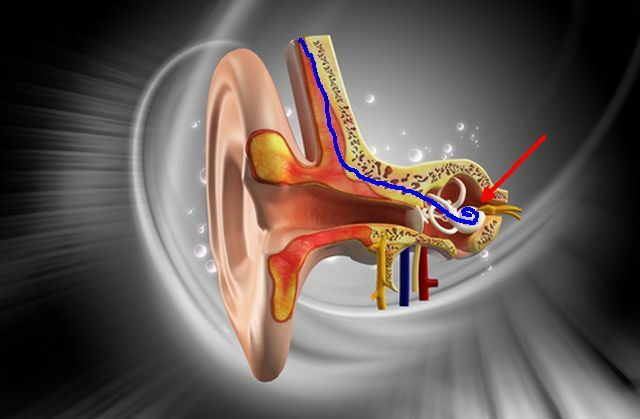 cochlear-implants2